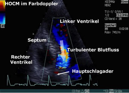 HOCM Farabdoppler echo